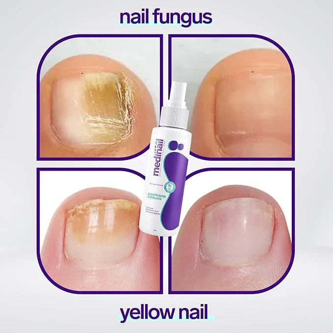 Jaysuing Nail Fungus Spray – Antifungal Treatment 100ml