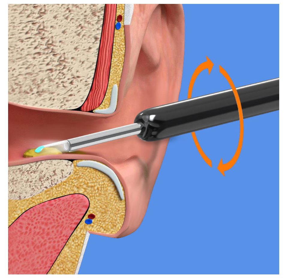 Smart Visual Earwax Removal Kit – HD Camera & Wi-Fi Ear Cleaner